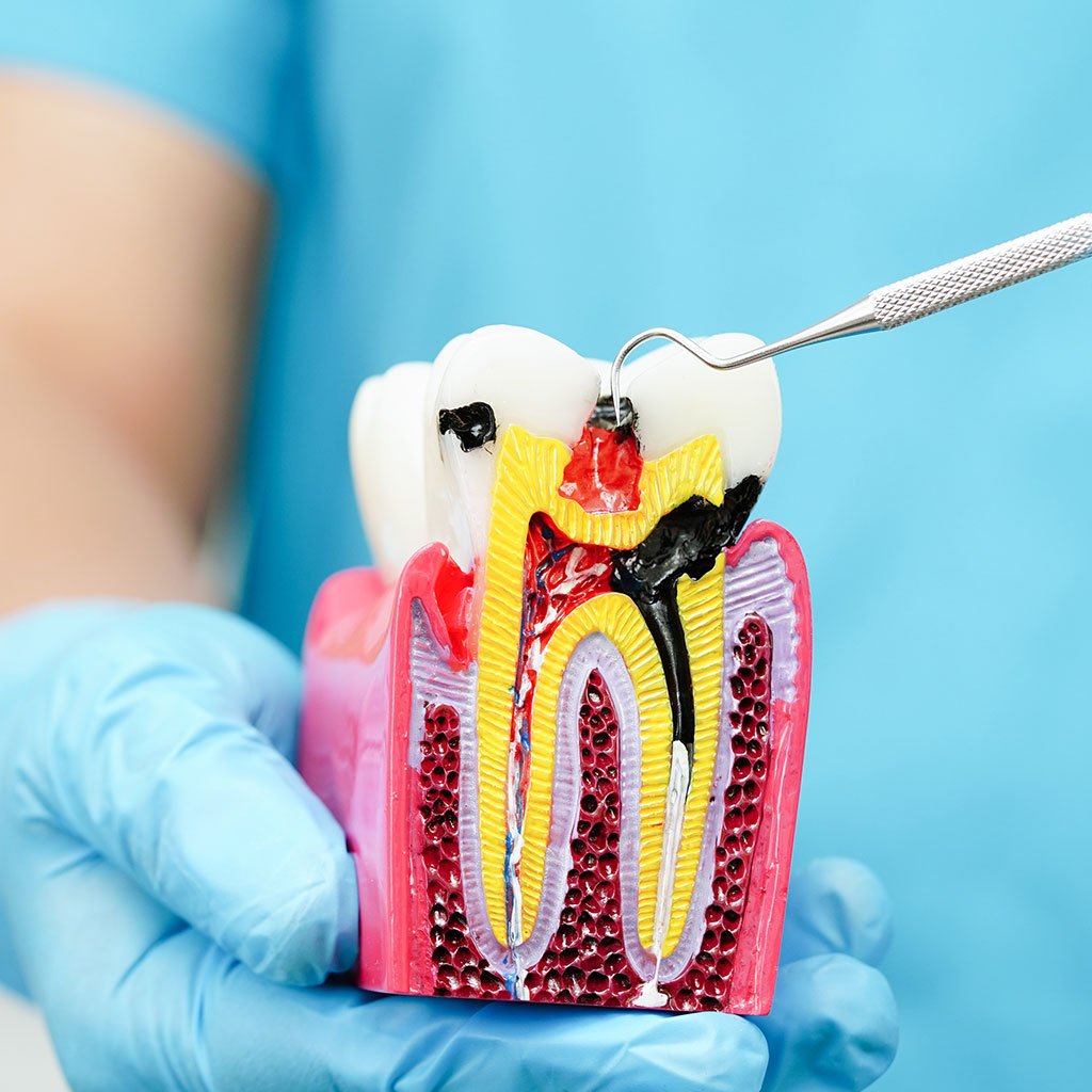 Endodontics (Root Canal Treatment)